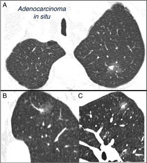 Nódulo pulmonar solitario subsólido mixto en lóbulo superior izquierdo. Tomografía computarizada torácica con cortes finos de 2mm en un paciente con un nódulo pulmonar solitario en lóbulo superior izquierdo. Corte axial (A) a nivel de lóbulos superiores y reconstrucciones coronal (B) y sagital (C) a nivel de lóbulo superior izquierdo. Se aprecia un nódulo pulmonar solitario en vidrio deslustrado de 18mm de diámetro máximo, con un componente sólido en su interior de 7mm. La resección mediante videotoracoscopia demostró adenocarcinoma in situ.