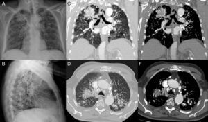 Radiografía posteroanterior (A) y lateral de tórax (B): opacidades bilaterales en lóbulos superiores de localización posterior (visibles en B), asociadas a pérdida de volumen, retracción hiliar y enfisema compensador de los lóbulos inferiores. Patrón nodular bilateral difuso. Adenopatías hiliares con calcificaciones periféricas en «cáscara de huevo». TC. Imágenes coronales (C, E) y axiales (D, F) en ventana de pulmón y mediastino, respectivamente: opacidades bilaterales en segmentos posteriores de lóbulos superiores con calcificaciones puntiformes en su interior. Enfisema paracicatricial entre la opacidad del lóbulo superior derecho y la pleura adyacente (asterisco). Múltiples nódulos centrolobulillares de distribución bilateral y difusa. Adenopatías mediastínicas e hiliares con calcificaciones en «cáscara de huevo» (flechas).