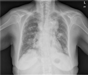 Radiografía de tórax posteroanterior en la que se aprecia masa en el lóbulo superior izquierdo y múltiples nódulos bilaterales sugerentes de metástasis.