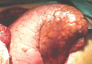 Imagen operatoria de la lesión situada en el lóbulo inferior del pulmón derecho.