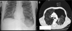A)Aumento de hiperclaridad pulmonar inferior izquierda. B)Neumotórax extenso.