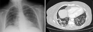 A)La radiografía de tórax en proyección posteroanterior muestra infiltrados alveolares bilaterales de predominio en la base pulmonar derecha. B)La TCAR torácica muestra infiltrados pulmonares bilaterales de predominio en los lóbulos inferiores, inespecíficos desde el punto de vista radiológico.