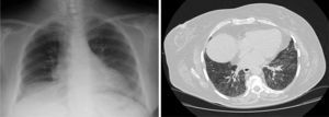 La radiografía de tórax posteroanterior y la TCAR torácica muestran mejoría de los infiltrados con persistencia de imágenes en vidrio deslustrado en el corte de TCAR.