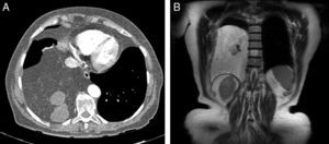 A)Imagen de TC torácica axial en la que se observa una masa adiposa heterogénea en el hemitórax derecho. Puede apreciarse una compresión esofágica y una afectación vascular. B)RM torácica con secuencia con ponderación T1 coronal que muestra una masa adiposa grande con varios nódulos quísticos y sólidos.