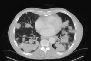 TC torácica en la que se aprecian lesiones nodulares pulmonares dispersas de contornos lobulados.