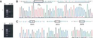 Identificación del alelo nulo PI*Q0ourém. A)Amplificación selectiva del alelo PI*no-S en 2 amplicones solapantes que cubren toda la región codificadora del gen SERPINA1 (NC_000014) y los intrones correspondientes. El fragmentoi (2.458pb; corriente arriba del sitio no-S) se amplificó con la pareja de cebadores TACTTGGCACAGGCTGGTTT//TACTTGGCACAGGCTGGTTT, y el fragmentoii (2.580pb; corriente abajo del sitio no-S) con la pareja GGGAAACTACAGCACCTGGA// GGCAGGGACCAGCTCAAC. Se resalta en negrita la posición 3’ del cebador específico de alelo que discrimina al alelo PI*S, lo cual requirió la optimización de la temperatura de anillado durante la PCR (70°C) (C: control negativo; CD: control de discriminación consistente en ADNg de un individuo con genotipo PI*SS; P: ADNg del paciente del caso 1). B-C)Electroforegramas de secuenciación del alelo PI*no-S amplificado mediante PCR específica de alelo. En B se indica con una caja el sitio afectado por la inserción de un nucleótido de timina, y se subrayan las secuencias de unión de las sondas diseñadas para la detección de dicha mutación. En C se muestran los codones y aminoácidos que definen el fondo genético M32.