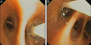 A)Balón de oclusión en el bronquio segmentario posterior del lóbulo inferior izquierdo. B)Balón de oclusión en el bronquio segmentario anterior del lóbulo inferior izquierdo. Válvulas endobronquiales colocadas en los bronquios segmentarios.