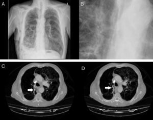 A)Radiografía de tórax con válvulas IVB en lóbulo superior derecho. B)Detalle de la radiografía de tórax con válvulas IBV en lóbulo superior derecho. C)TC de tórax en paciente con enfisema bulloso y válvula IBV colocada en B2 derecho (señalada por fecha). D)TC de tórax en paciente con enfisema bulloso y válvula IBV colocada en B1 derecho (señalada por flecha). Paciente con neumotórax derecho y enfisema pulmonar (paciente n.¿ 5).