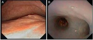 Visualización pre y poscolocación de endoprótesis de Montgomery, ajustada. A)Malacia en la que se muestra el lumen del bronquio principal derecho en espiración. B)Visión endoprotésica que muestra hacia el lateral derecho la entrada al bronquio lobar superior