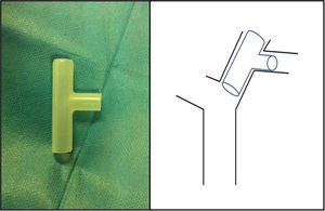 Endoprótesis de Montgomery, ajustada.