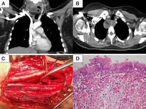 A y B) Imagen en TAC de masa quística cervical derecha con nivel hidroaéreo en su interior. C) Imagen operatoria, con vena yugular interna y arteria carótida externa disecadas, y cápsula del quiste broncogénico traccionado con pinza de Adson. D) Epitelio de tipo respiratorio tapizando la superficie del quiste (H&E 40×).