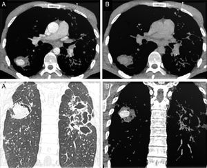 Cortes axiales de TC en ventana de mediastino: lesión en el LID, de bordes bien definidos, con captación de contraste en fase arterial (A superior) y lavado en fase venosa (B superior). Cortes coronales de TC en ventana de parénquima (A inferior) y en ventana de mediastino (B inferior) en fase arterial: lesión nodular captante en LID e imágenes de bronquiectasias y cavitaciones extensas en hemitórax izquierdo.