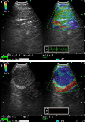A) La imagen de USEB convencional en modoB de escala de grises (izquierda) y en modo elastografía en tiempo real mediante USEB (derecha) muestra un ganglio linfático subcarinal benigno de 6,6mm, visualizado como un área de rigidez intermedia (verde). B)La imagen de elastografía por USEB (derecha) muestra una adenopatía subcarinal maligna de 12,6mm que se visualiza como un área dura (azul oscuro-cian) debida a infiltración ganglionar por carcinoma escamoso.