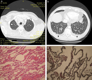 Reconstrucción volumétrica con TCAR en ventana de parénquima de los lóbulos pulmonares superior (a) e inferior (b) mostrando engrosamiento liso multifocal de los septos interlobulillares (flechas blancas) y derrame pleural bilateral leve (flechas negras). Las características histopatológicas (c) incluyeron engrosamiento marcado de los septos interlobulillares y las paredes alveolares, ocupados por una extensa proliferación de vasos sanguíneos de pared delgada y pequeñas áreas de inflamación linfocítica intersticial (tinción de hematoxilina y eosina; magnificación 30×). Las células endoteliales eran positivas a tinción con el anticuerpo monoclonal CD31 (d) (magnificación 40×).