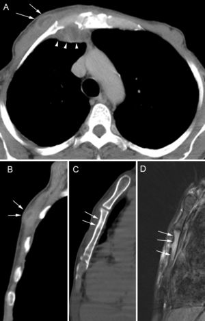 Imágenes del TAC torácico axial (A) y sagital (B) reformateadas que muestran una acumulación hipodensa en los tejidos blandos de la pared torácica anterior derecha, al lado del esternón (flechas). La acumulación se comunica con otra parietal interna (puntas de flecha). Otra imagen sagital (C) muestra el engrosamiento de hueso cortical en la superficie anterior del cuerpo esternal (flechas). Una imagen de RM sagital en T2 con saturación de grasa (D) muestra señal de alta intensidad de la médula ósea del esternón.