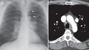 A) Radiografía de tórax, proyección posteroanterior: doble contorno en la línea mediastínica izquierda (flechas), debido al trayecto ascendente del vaso venoso anómalo. B) Tomografía computarizada con contraste, plano axial: vaso venoso anómalo paraaórtico izquierdo (cabeza de flecha), responsable del doble contorno.