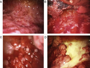 Variados aspectos toracoscópicos del mesotelioma pleural maligno. A. Infiltración masiva de la pleura parietal por mesotelioma maligno de tipo epitelioide. B. Infiltración difusa de la pleura parietal y visceral por mesotelioma maligno de tipo epitelioide. C. Nódulos «perlados» en afectación masiva de la pleura parietal por mesotelioma de tipo epitelioide. D. Placas pleurales y masas de mesotelioma de tipo sarcomatoso en la pleura parietal.