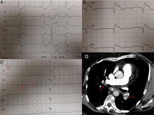 (A y B). Electrocardiograma compatible con infarto agudo de miocardio con elevación del segmento ST en cara inferior y con afectación de ventrículo derecho. (C). ECG que muestra patrón de McGuin-White (S1Q3T3). (D). AngioTAC pulmonar, defectos de replección en las ramas principales de las arterias pulmonares (flechas).