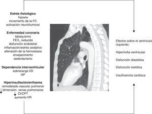 Figura que resume los mecanismos fisiopatológicos involucrados y sus efectos sobre el ventrículo izquierdo en la EPOC. CI/CPT: ratio entre la capacidad inspiratoria y la capacidad pulmonar total; FC: frecuencia cardíaca; FEV1: volumen espiratorio forzado en el primer segundo; HP: hipertensión pulmonar; VD: ventrículo derecho; VR: volumen residual.