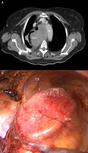 A) Tomografía axial computarizada. Corte transversal torácico a nivel del cayado de la aorta. Se aprecia el schwannoma (SCH) y el cayado aórtico (AO). B) Imagen intraoperatoria. Esófago (E) aplanado, sonda nasogátrica (SNG), schwannoma (SCH), costilla (CS) y vena ácigos (AC).
