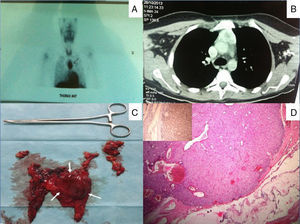 A) Estudio preoperatorio con 99mTc-MIBI mostrando un foco voluminoso de hipercaptación en el mediastino. B) TAC de tórax que muestra una gran masa situada en el área del timo del mediastino anterior. C) Imagen postoperatoria tras la timectomía total que muestra el adenoma paratiroideo ocupando casi todo el lóbulo izquierdo del timo. D) Histopatología postoperatoria donde se observa el adenoma paratiroideo rodeado de tejido normal del timo. Inmunotinción positiva para hormona paratiroidea (recuadro).
