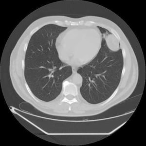 Tomografía computarizada multicorte que muestra un nódulo pulmonar redondo homogéneo e intraparenquimatoso con localización periférica en la língula del pulmón izquierdo. La lesión está en contacto con el pericardio y la pleura parietal.