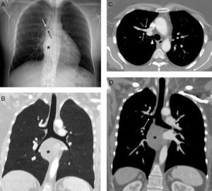 A) Radiografía de tórax en la que se observa una masa mediastínica (asterisco) que oblitera la línea pleuro-ácigos-esofágica y un posible bronquio traqueal (flechas). B) Reconstrucción coronal minIP (proyección de mínima intensidad) que confirma la existencia del bronquio traqueal. Nótese la masa mediastínica (asterisco). C) Imagen axial de TC de tórax con contraste intravenoso en la que se visualiza un drenaje anómalo de la vena pulmonar del lóbulo superior derecho en la vena cava superior (flechas) y el bronquio traqueal (cabeza de flecha). D) Imagen coronal oblicua de TC de tórax con contraste intravenoso en la que se aprecia el bronquio traqueal (flecha) y la masa mediastínica (asterisco).