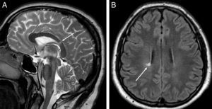 RM de cráneo. Imagen sagital potenciada en T2 (A) en la que se observa una lesión focal hiperintensa en el esplenio del cuerpo calloso (flecha blanca). Imagen axial FLAIR (B) en la que se visualiza una lesión focal hiperintensa en la sustancia blanca periventricular (flecha blanca). Ambas lesiones son inespecíficas desde el punto de vista radiológico, pero en un contexto clínico adecuado compatibles con una enfermedad desmielinizante.