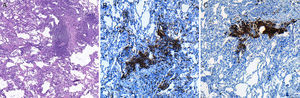 Imagen de microscopia óptica sobre corte histológico de biopsia pulmonar realizada mediante criobiopsia, donde se observa: A)el buen grado de conservación de las estructuras alveolares de la muestra, así como la presencia de infiltrado inflamatorio de predominio linfocitario localizado en el intersticio (hematoxilina-eosina, 40×). B)El estudio inmunohistoquímico muestra la presencia de linfocitosT (marcaje de CD3; 100×) y C)de linfocitosB (marcaje de CD20, 100×). El paciente fue diagnosticado de neumonía intersticial linfocitaria, sin evidencia de linfoma.