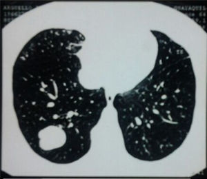 Tomografía computarizada torácica que muestra imagen de tejidos blandos con coeficiente de atenuación de grasa de contornos irregulares con una macrocalcificación en el interior de 4×3cm.