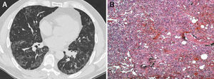 A) TCAR de tórax en la que se observa una borrosidad en vidrio esmerilado y una opacidad reticular periférica que se manifiestan especialmente en las bases pulmonares. B) El examen histopatológico mostró lo siguiente: tabiques alveolares ensanchados con proliferación de neumocitos tipo ii e infiltrado inflamatorio mononuclear con fibrosis intersticial en un patrón en parches (patchwork pattern) que sugería una neumonía intersticial usual (tinción de hematoxilina-eosina, aumentos originales 100×).