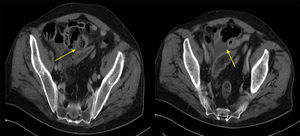 TC abdominal: engrosamiento mural de un segmento de intestino delgado (yeyuno), cambios inflamatorios y burbujas de aire extraluminales adyacentes.