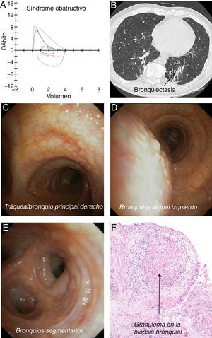 A: La función pulmonar mostró una obstrucción leve. B: La TC de tórax mostró principalmente bronquiectasias en el lóbulo inferior izquierdo. C-E: La broncoscopia reveló la presencia de lesiones granulosas minúsculas diseminadas, que se extendían de la parte superior de la tráquea a los bronquios segmentarios y subsegmentarios bilaterales, con una distribución circular en todas las partes membranosas y cartilaginosas de las vías aéreas. F: Granulomas de células epitelioides no caseosos.