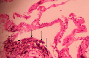 Corte de biopsia pulmonar transbronquial que muestra depósitos antracóticos (puntas de flecha) en haces peribroncovasculares, así como tabiques interlobulillares sin signos de fibrosis (tinción de hematoxilina y eosina, aumentos originales×400).
