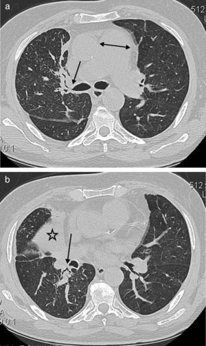Un varón de 64 años de edad con tos y disnea. a) Imagen de TC a nivel del tronco de la arteria pulmonar que muestra un engrosamiento de tejido blando peribronquial central (flecha) y estenosis del bronquio del LSD. Se observa también el agrandamiento del tronco de la arteria pulmonar (doble punta de flecha). b) TC de tórax con ventana temporal que muestra el colapso del LMD (estrella), así como un engrosamiento del tejido blando peribronquial del LID (flecha) con obliteración del bronquio del segmento apical del lóbulo inferior derecho.
