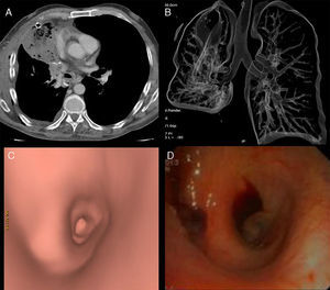 Se observa consolidación expansiva de lóbulo medio, que contiene burbujas de aire (A), y distorsión de la anatomía bronquial derecha (B). Correlación entre reconstrucción virtual y broncoscopia óptica que demuestra afilamiento de luz aérea de bronquio lobar medio (C y D).