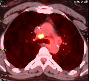 Imagen 18FDG PET/CTque muestra hipermetabolismo intenso (SUVmax=5,1) de los ganglios linfáticos del mediastino en el caso 2.