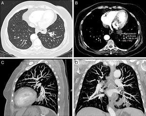 TC de tórax, imágenes axiales con ventana de pulmón (A) y mediastino (B) donde se identifica una consolidación en la base pulmonar izquierda con centro de densidad grasa (−33UH). Las reconstrucciones sagital (C) y coronal (D) demuestran la localización peribronquial de la consolidación del lóbulo inferior izquierdo.