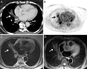 Imagen axial de TC de tórax en ventana de mediastino (A) en la que se observa una opacidad en pulmón derecho de distribución peribronquial, con áreas de atenuación grasa (flecha). Imagen de PET (B) en la que se observan áreas hipermetabólicas en la base pulmonar derecha, coincidiendo con las opacidades visualizadas en TC (flecha). Imágenes axiales de RM, en la que se demuestra hiperintensidad de señal de la opacidad en secuencias potenciadas en T1 (C) y supresión de su señal en secuencia de saturación grasa (D) (flechas).