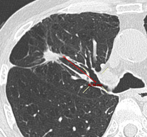 Imagen reformateada utilizada para calcular la distancia del nódulo al hilio.