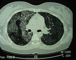 Tomografía computarizada de alta resolución (TACAR) de un pacientes con proteinosis alveolar pulmonar (PAP) que muestra las características clásicas de los septos interlobulillares engrosados contra un fondo de opacidades en vidrio esmerilado, dando la típica una apariencia de crazy paving.