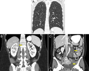 Hallazgos radiológicos del caso, caracterizado por A) la existencia de múltiples quistes pulmonares, B) una masa renal derecha (flecha amarilla) y C) múltiples lesiones quísticas redondeadas en retroperitoneo (flechas amarillas) y pelvis.