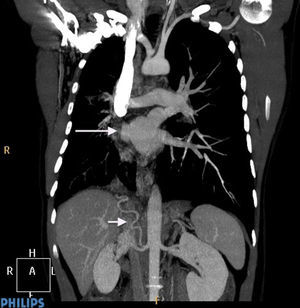 La TAC muestra ausencia de venas pulmonares derechas desembocando en aurícula izquierda, así como la arteria subfrénica inferior con origen en la arteria renal derecha.