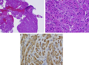 A) A pequeños aumentos se aprecia zona de epitelio bronquial (arriba a la derecha, más oscuro) y el resto está formado por la tumoración. B) A grandes aumentos se aprecian las células con morfología fusiforme y citoplasma granular. Schwannoma bronquial o tumor de células granulares. C) Inmunohistoquímica positiva para S100 (coloración más oscura).