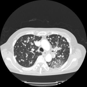 TAC torácico. Imagen que muestra la presencia de múltiples nódulos pulmonares bilaterales tras la progresión a erlotinib.