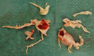 Material quirúrgico extraído en una tromboendarterectomía pulmonar.