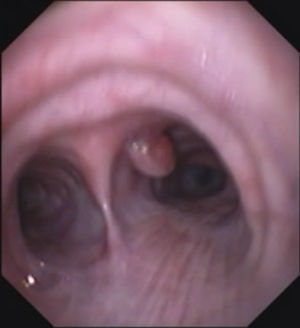 Fibrobroncoscopia. Se muestra la lesión en bronquio principal derecho.