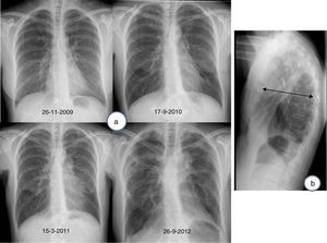 a) Radiografía de tórax (proyección postero-anterior): Evolución de un caso de fibroelastosis pleuropulmonar, caracterizada por una pérdida progresiva de volumen pulmonar a expensas de los lóbulos superiores, con una retracción ascendente de ambos hilios, así como por engrosamientos pleurales biapicales. b) Radiografía de tórax (proyección lateral): aplanamiento de la caja torácica; obsérvese la disminución del diámetro anteroposterior de la caja torácica (flecha) en relación con el diámetro cráneo-caudal.