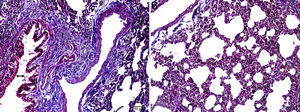 Examen histopatológico mediante microscopia óptica del tejido pulmonar en el grupo MTX, tinción tricrómica de Masson. d: células en degeneración; e: edema; f: fibrosis; flecha fina: pérdida de células epiteliales; MTX: metotrexato; v: vacuolización.