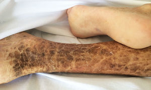 Fotografía de la cara posteromedial de la pierna derecha del paciente. Se observan las lesiones típicas de la ictiosis: una piel seca y áspera con escamas hiperpigmentadas de tonos amarronados, con bordes poligonales, libres e irregulares.